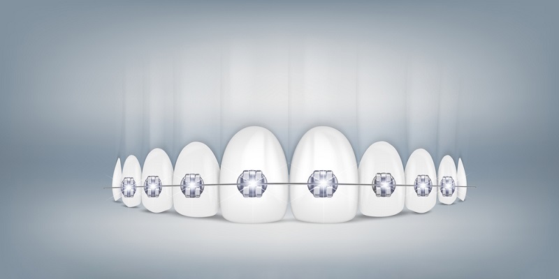 braces cost in india 